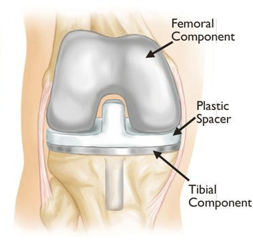 total knee implant - Edited