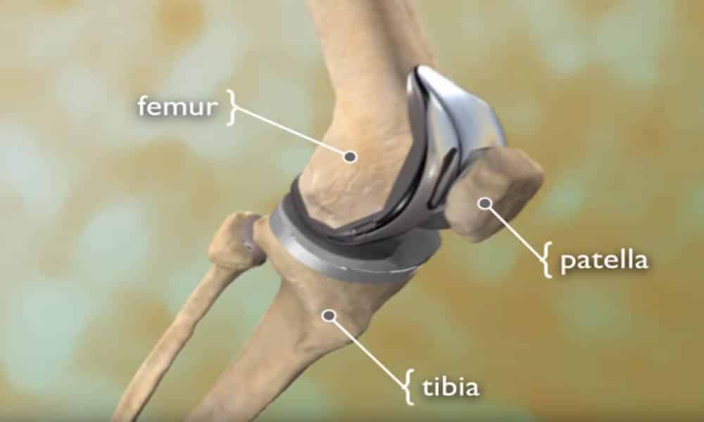 total-knee-replacement