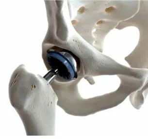 Robotic Hip Replacement