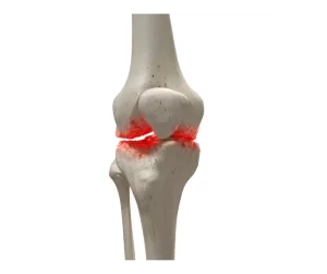 the arithritis knee