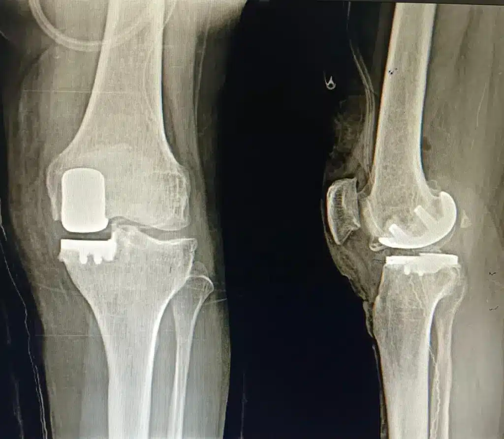 partial robotic knee replacement